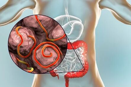 Parasites in the bowels